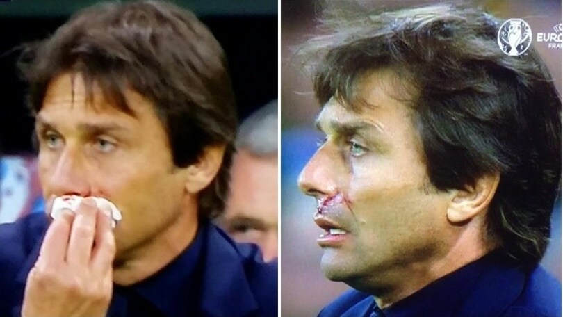 Euro 2016, Belgio-Italia: Conte perde sangue dal naso!
