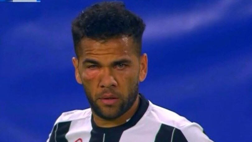 Juventus-Lione, Dani Alves: botta all'occhio e volto da pugile