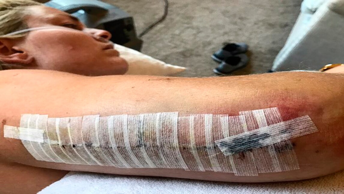 Vonn, cicatrici e bende dopo l'intervento