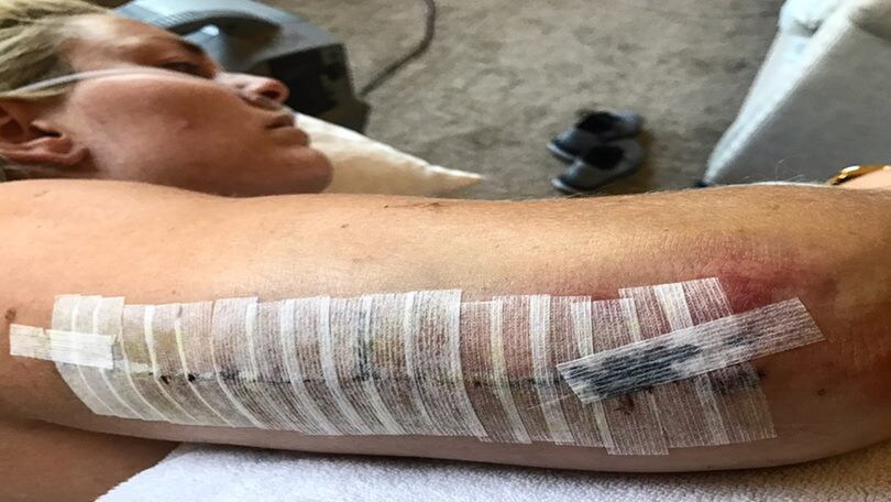 Vonn, cicatrici e bende dopo l'intervento
