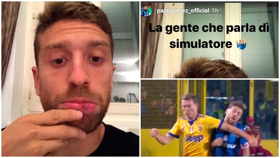 Atalanta, Gomez si difende e mostra il labbro gonfio