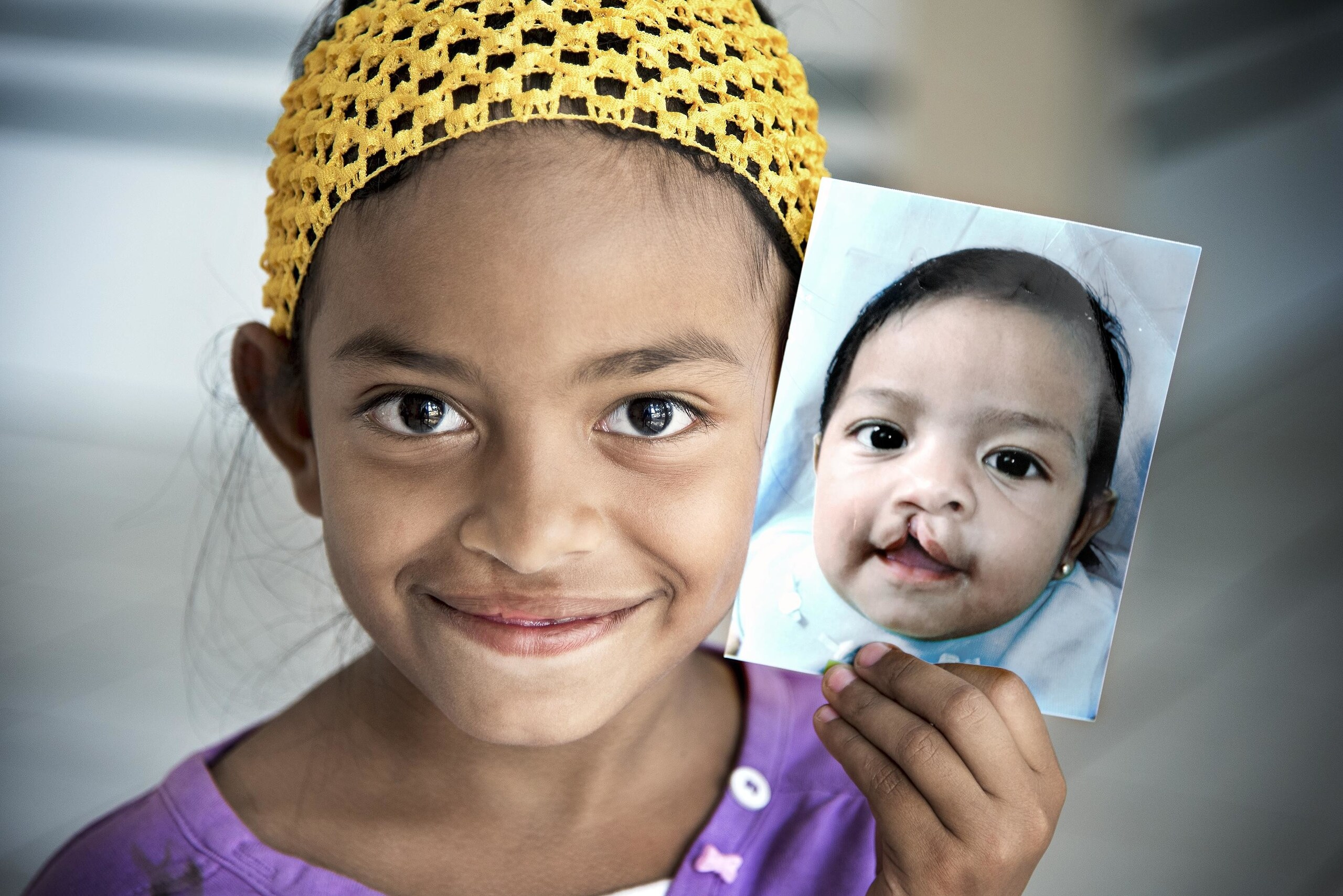 Fondazione Operation Smile Italia tra i charity partner di Acea Run Rome The Marathon