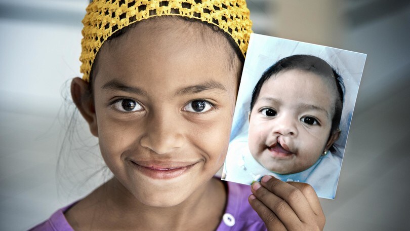 Fondazione Operation Smile Italia tra i charity partner di Acea Run Rome The Marathon