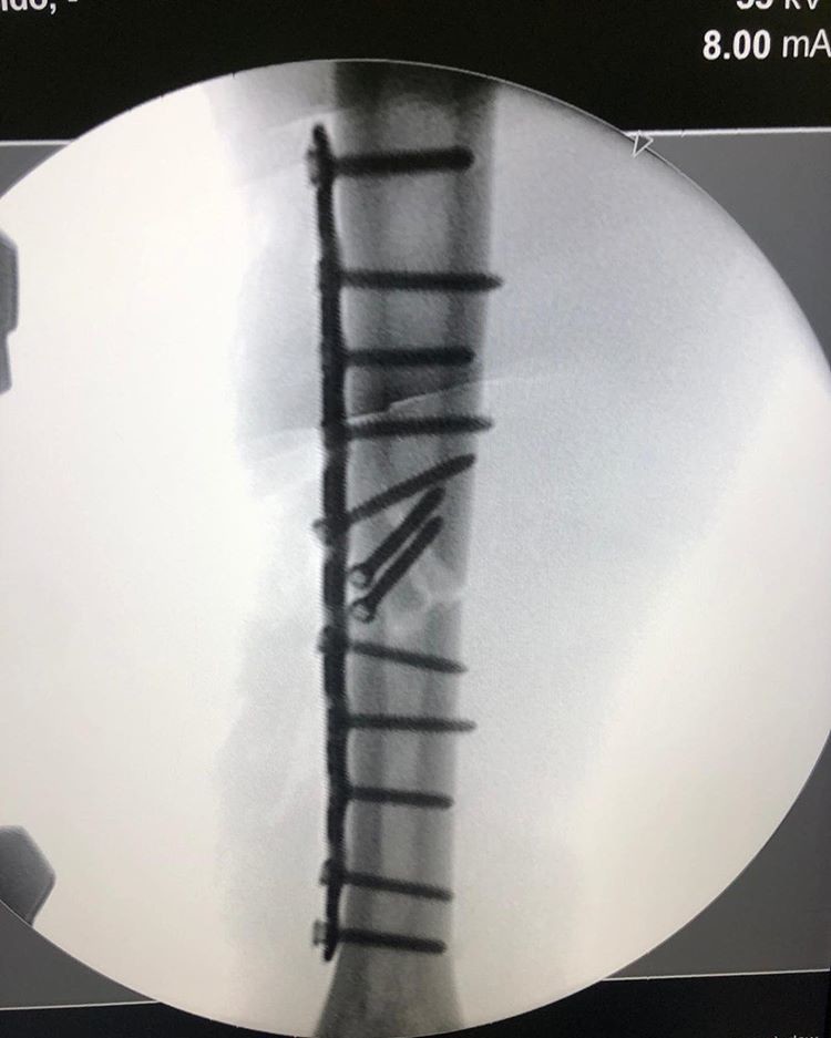 Marquez, la radiografia del braccio sui social: 12 chiodi per ridurre la frattura!