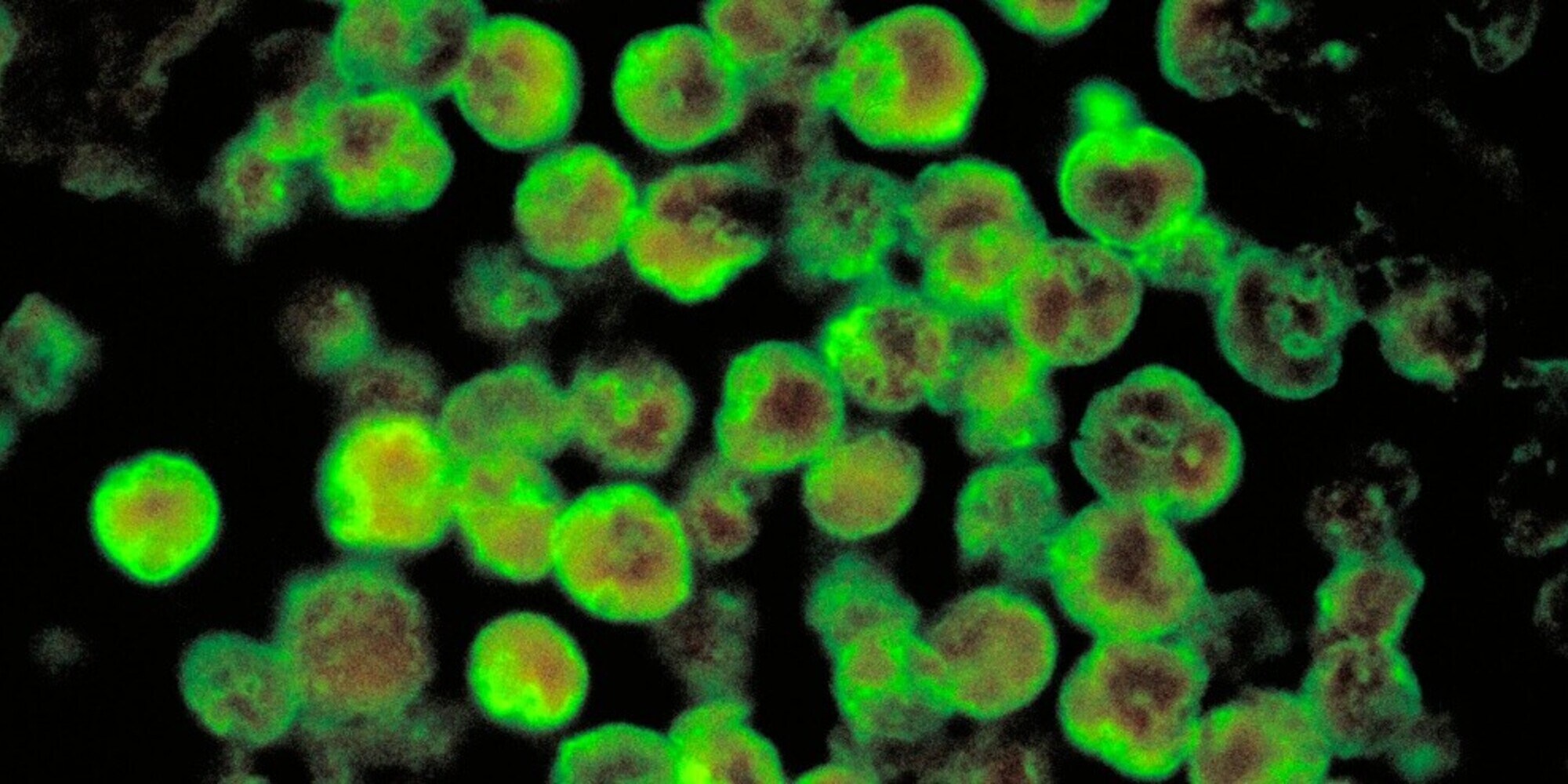 Ameba mangia-cervello: cos’è, sintomi e perché può portare alla morte