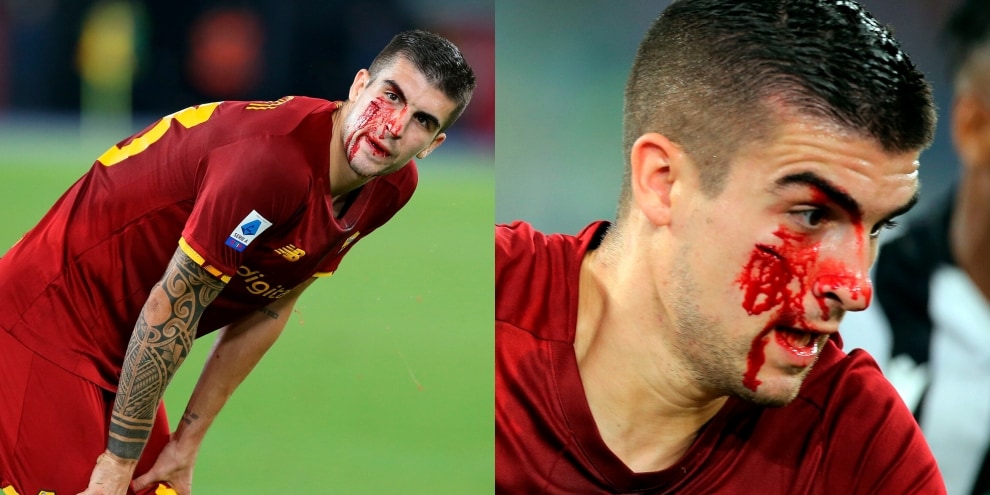 Mancini, duro scontro: perde sangue in campo
