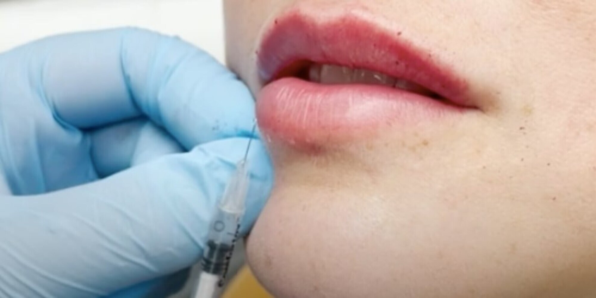 Troppi ritocchini negli under 18: l’allarme dei medici