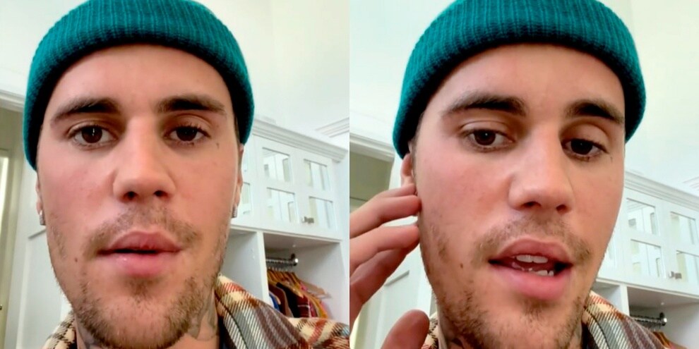 Justin Bieber in un video mostra la sua paresi facciale
