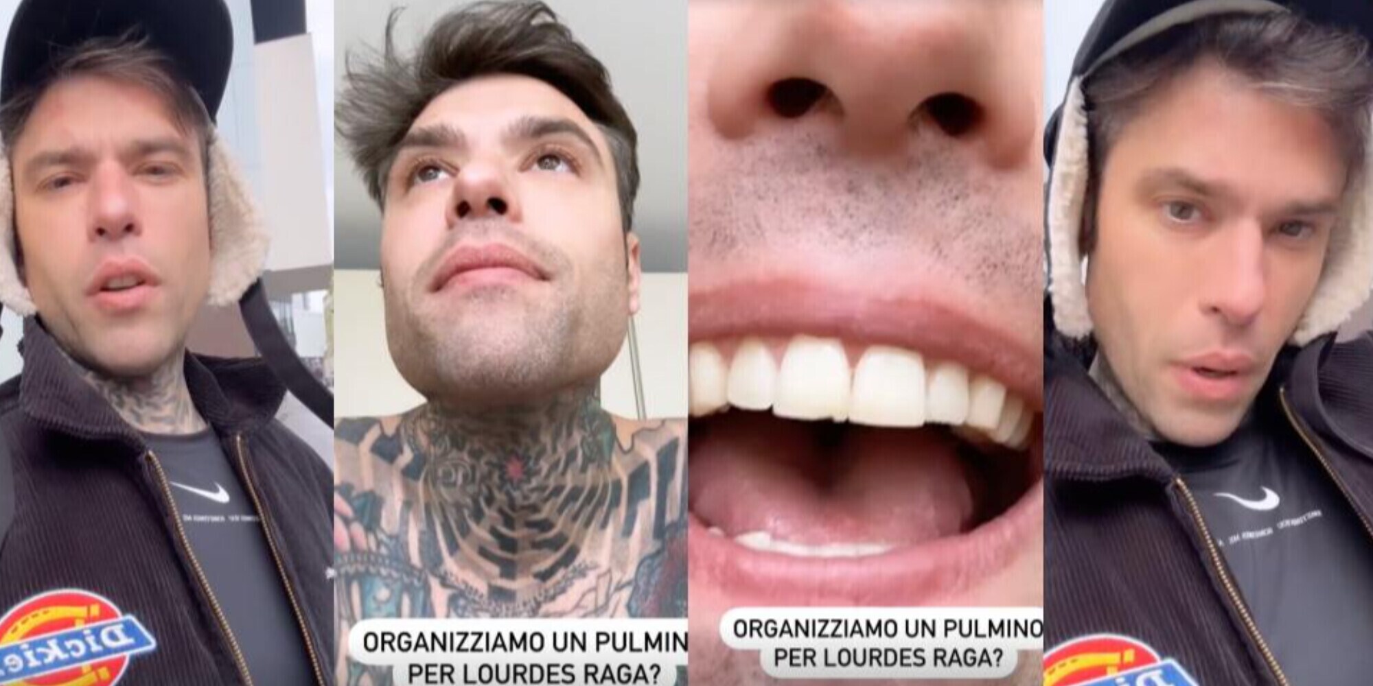 Fedez senza pace: dente rotto per colpa di un pugno, cos'è successo