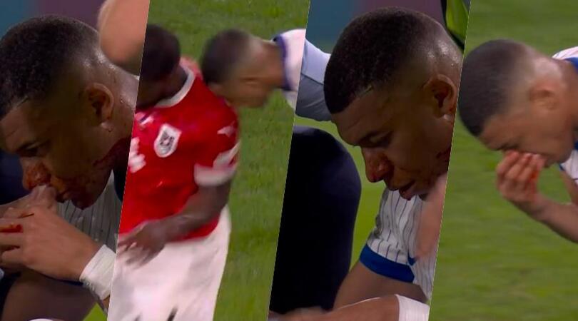 Mbappé, scontro durissimo con Danso: Kylian ko al naso, esce dal campo sanguinante