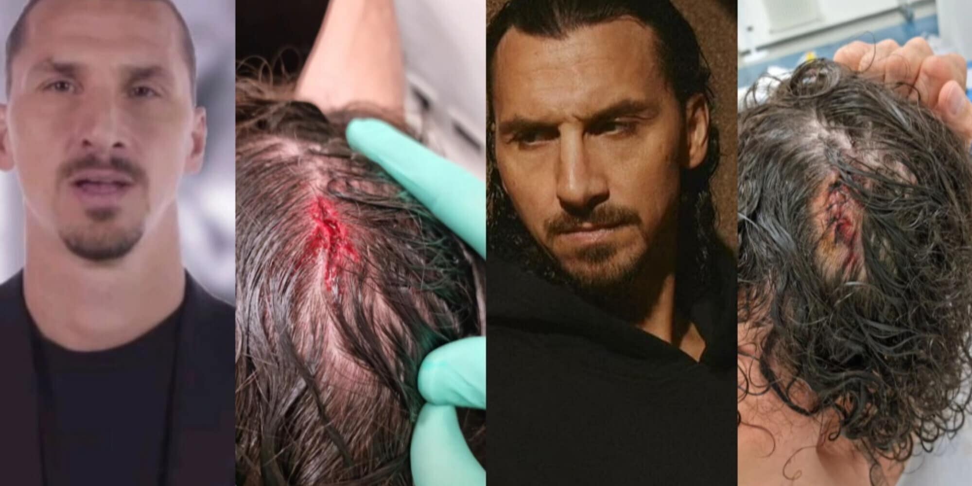 Ibrahimovic, il taglio alla testa non impressiona i fan: "Zlatan non sente dolore, è il dolore che sente Zlatan"