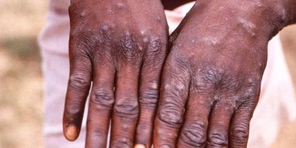 Vaiolo scimmie, l'allarme dell'Oms: "Europa epicentro della diffusione"