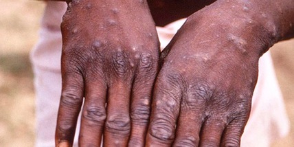 Vaiolo delle scimmie, in Italia aumentano i casi: sono 644