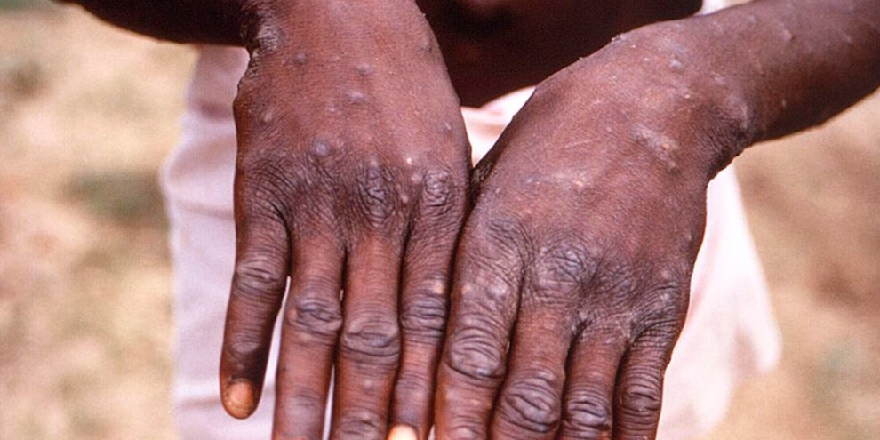 Vaiolo delle scimmie: al via la vaccinazione in Italia