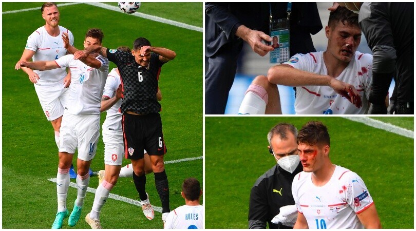 Schick in una maschera di sangue: gomitata di Lovren e naso ko