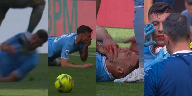 Casale, volto insanguinato dopo lo scontro con Theo Hernandez in Milan-Lazio