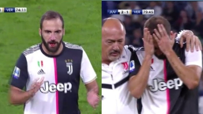 Juve-Verona, Higuain si fa male: sangue dal naso dopo uno scontro