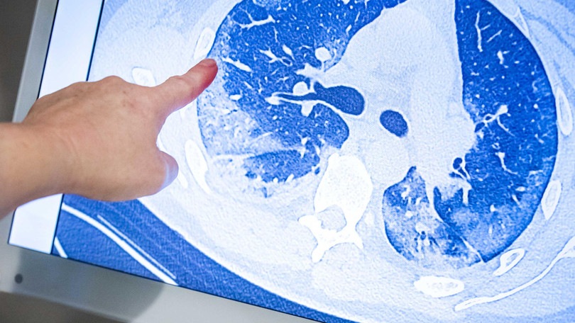 Richeldi: “Il 30% dei guariti da Coronavirus avrà danni ai polmoni”