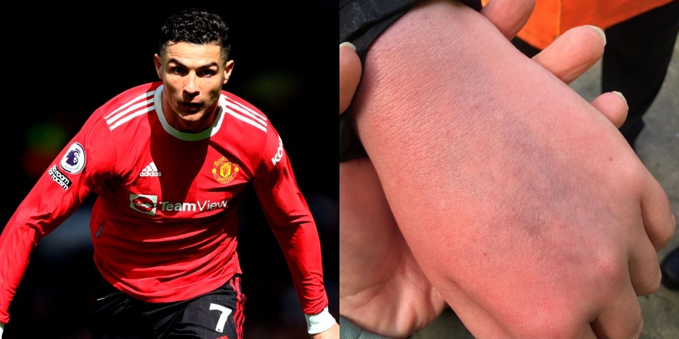 "Cristiano Ronaldo è un delinquente, ecco i lividi di mio figlio" FOTO