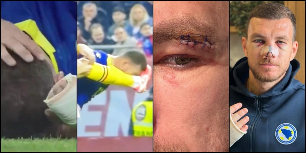 Dzeko da horror, calcio in faccia e naso rotto: cosa è successo