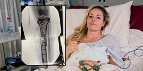 Vonn, la gamba fa paura ma lei scherza: "Ora sono diventata bionica davvero"