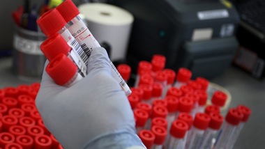 Mappato il virus dell'Hiv del 1966: si è conservato nella paraffina