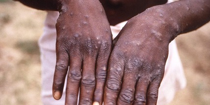 Vaiolo delle scimmie, l'Italia tra i paesi più colpiti