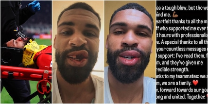 Trauma facciale per Loftus-Cheek, intervento ok ma foto shock sui social: per quanto lo perde il Milan