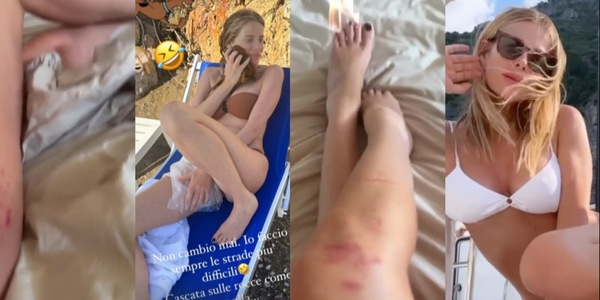 Alessia Marcuzzi mostra le ferite e lividi dopo la caduta a Formentera