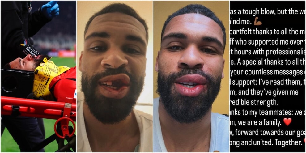 Trauma facciale per Loftus-Cheek, intervento ok ma foto shock sui social: per quanto lo perde il Milan